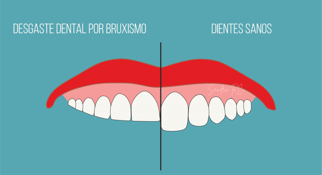 DESGASTE DENTAL ¿COMO SÉ SI TENGO BRUXISMO?  - Blog Cervera Dental